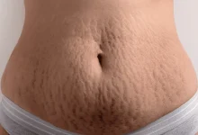 علت ترک پوستی چیست؟