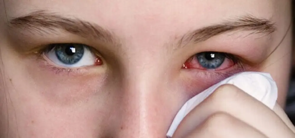 از مشکلات استفاده نادرست از لنز های تماسی، عفونت های  چشمی است